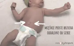 Rozejście mięśnia prostego brzucha u dziecka: objawy i leczenie.