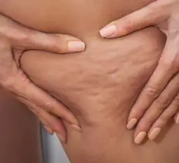 Jak pozbyłam się cellulitu? Mój osobisty plan na gładką skórę