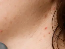 Pryszcze na szyi co oznaczają i jak skutecznie je leczyć