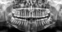 Czy ósemki rosną na górze? Prawda o zębach mądrości w jamie ustnej