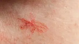 Jak wygląda cera naczynkowa? Rozpoznaj objawy i skutecznie ją pielęgnuj.