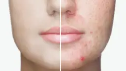 Pryszcze: Co naprawdę działa? Skuteczny plan pielęgnacji i leczenia