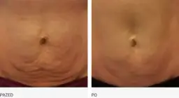 Endermologia jak długo utrzymują się efekty i co na nie wpływa?