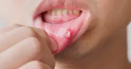 Masz opryszczkę? Dentysta odmówi! Co robić i kiedy iść?