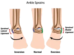 Skręcona kostka jak długo trwa leczenie i powrót do sprawności
