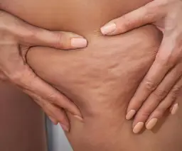 Jak pozbyć się cellulitu z ud? Skuteczne metody i porady eksperta
