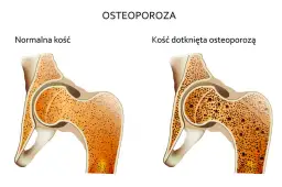 Osteoporoza przyczyny: Jak uniknąć utraty gęstości kości?