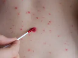 Leki na rozwolnienie: Co wybrać? Przewodnik po skutecznych opcjach