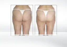 Endermologia: Kiedy efekty i jak utrzymać je na dłużej?