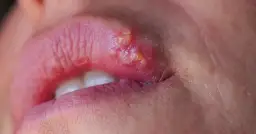 Zbliżenie na usta z widocznymi pęcherzykami opryszczki na wardze.