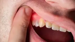 Ropa w dziąśle: Co robić? Szybka ulga i kiedy do dentysty