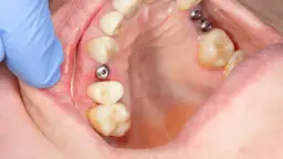 Implant zęba: Poznaj fakty! Zabieg, zalety, cena Twój nowy uśmiech