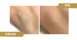 Depilacja laserowa co 2 tygodnie? Dlaczego to błąd i co robić?