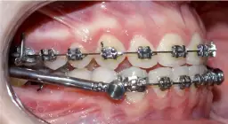 Czy aparat na zęby powiększa usta? Odkryj prawdę o ich wyglądzie