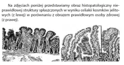 Celiakia - charakterystyczne objawy choroby trzewnej