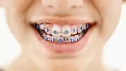 Kiedy aparat stały dla dziecka? Ortodonta radzi: wiek, koszty, proces