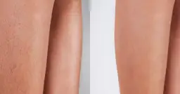 Depilacja laserowa: Przygotowanie krok po kroku. Bezpieczeństwo i efekt!