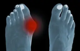 Jak rozpoznać haluksa: objawy, które mogą zaskoczyć każdego