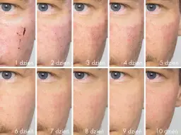 Jak dbać o skórę po laserze frakcyjnym, aby uniknąć problemów?