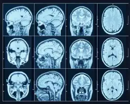 Czy rezonans wykryje choroby psychiczne? Prawda o MRI głowy