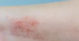 Alergia u dziecka: Jaki lek wybrać? Kiedy do lekarza?