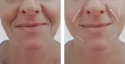 Bruzdy nosowo-wargowe: Botox czy kwas hialuronowy - co wybrać?