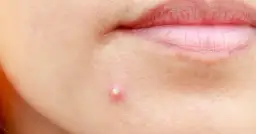 Pasta na pryszcze? Zobacz, dlaczego to szkodzi i co naprawdę pomaga!