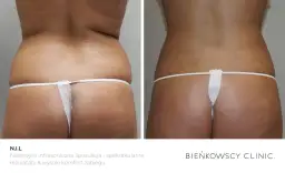 Liposukcja bezpieczna? Poznaj ryzyko i podejmij świadomą decyzję