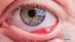 Jęczmień na oku: Jak leczyć w domu i kiedy iść do lekarza?