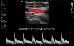 USG doppler tętnic szyjnych: obraz tętnicy z przepływem krwi (czerwony) i wykres prędkości przepływu.