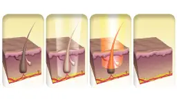 Jak działa depilator laserowy? Odkryj skuteczność i różnice