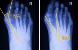 Haluks: Operacja krok po kroku. Co musisz wiedzieć przed zabiegiem?