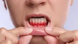 Co na ból dziąseł? Sprawdzone metody, leki i alarmujące objawy