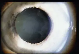 Jakie są objawy jaskry barwnikowej i jak je rozpoznać?