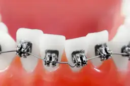 Czy aparat na zęby jest modny? Odkryj trendy i nowoczesne rozwiązania