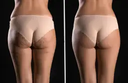 Jak pozbyć się cellulitu z ud? Skuteczne metody i zabiegi