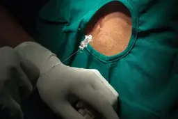 Płyn mózgowo-rdzeniowy: co wykrywa? Infekcje, SM, nowotwory