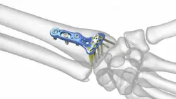 Ile trwa rehabilitacja po złamaniu nadgarstka? Kluczowe informacje o czasie powrotu do zdrowia