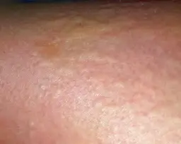 Gluten intoleranz symptome: Erkennen Sie die versteckten Anzeichen