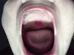 Objawy kiły w jamie ustnej: jak je rozpoznać i uniknąć powikłań