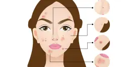 Mapa trądziku: Co lokalizacja pryszczy mówi o Twoim zdrowiu?