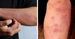 Objawy skórne raka jelita grubego: Kiedy iść do lekarza?