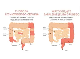 Choroby autoimmunologiczne jelit: 5 głównych przyczyn i terapii