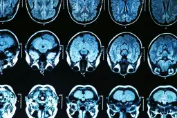 Parkinson: Psychiczne aspekty zrozum, lecz, żyj lepiej