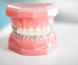 Jak wyglądają aparaty na zęby? Różnice, estetyka i komfort noszenia