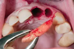 Palenie po dentyście: Suchy zębodół, implanty. Jak długo czekać?