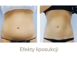 Po liposukcji tłuszcz wraca? Nie! Jak utrzymać nową sylwetkę