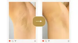 Jak pielęgnować skórę po depilacji depilatorem, aby uniknąć podrażnień