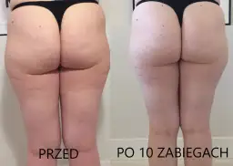 Masaż bańką chińską na cellulit: Instrukcja krok po kroku i efekty