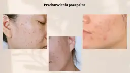 Czerwone plamy po pryszczach: Jak skutecznie pozbyć się PIE?